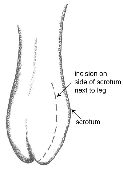 Incision method A.