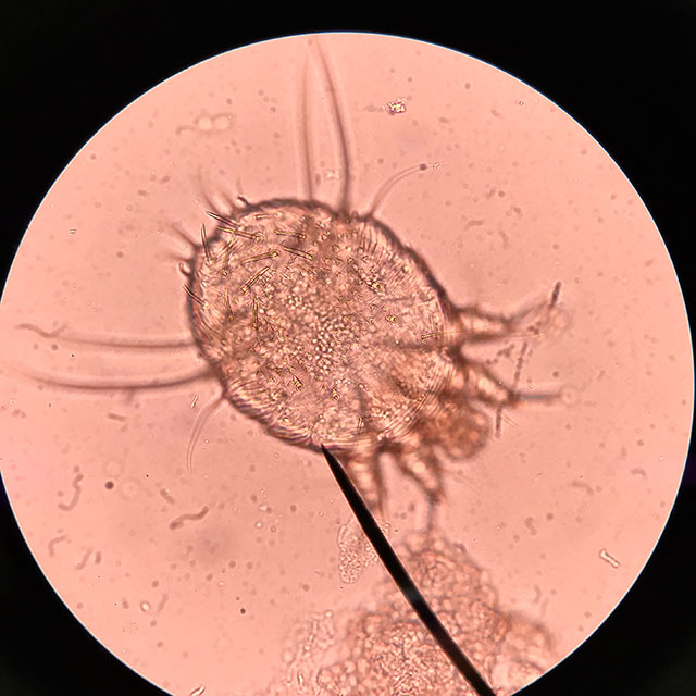 Image de l’acarien sarcopte de la gale sous lentille microscopique.